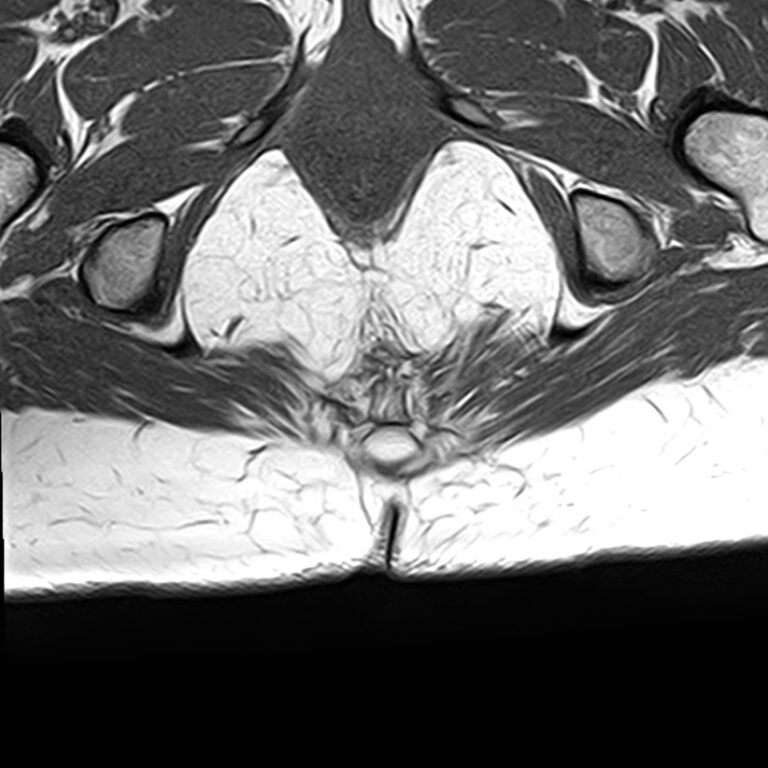 МРТ копчика, режим Т1, косо-корональная плоскость