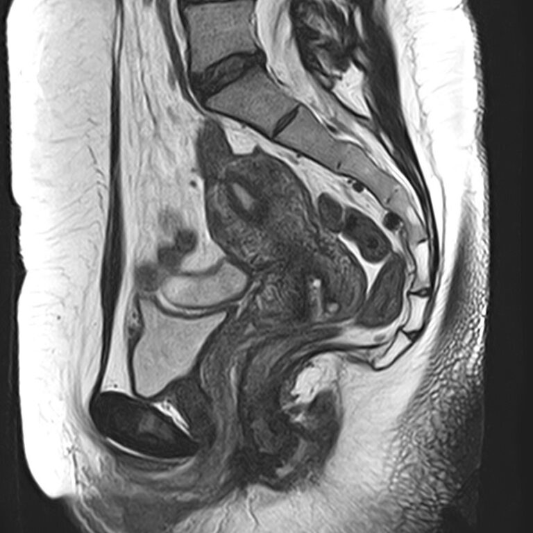 МРТ копчика, режим Т2, сагиттальная плоскость