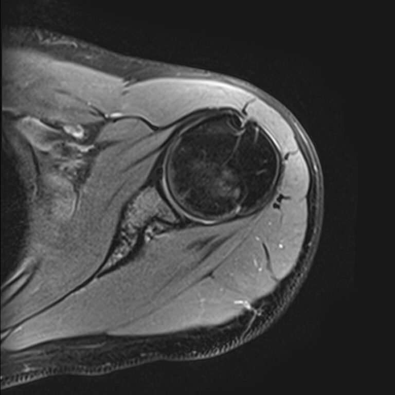 МРТ плечевого сустава, режим Pd FS, аксиальная плоскость