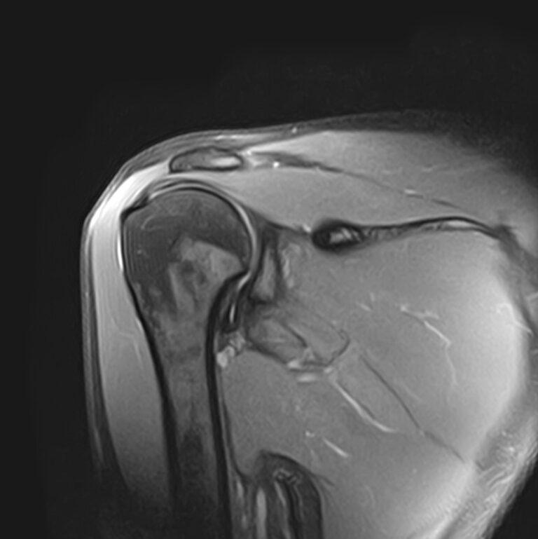 МРТ плечевого сустава, режим Pd FS, корональная плоскость