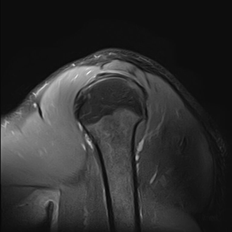 МРТ плечевого сустава, режим Pd FS, сагиттальная плоскость