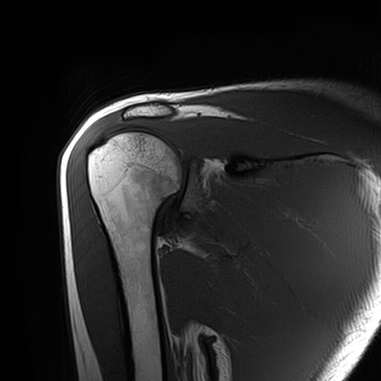 МРТ плечевого сустава, режим Т1, корональная плоскость