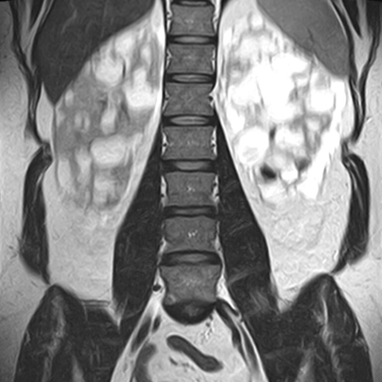 МРТ пояснично-крестцового отдела позвоночника, режим Т2, корональная плоскость