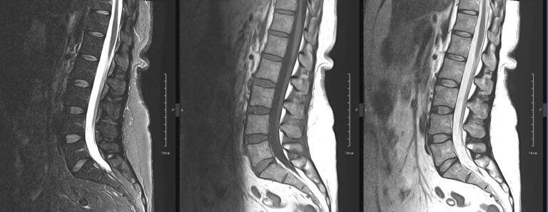 МРТ пояснично-крестцового отдела позвоночника, сагиттальная плоскость, режимы слева направо - STIR, Т1, Т2