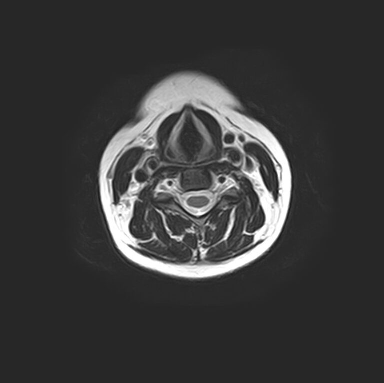 МРТ шейного отдела позвоночника, режим Т2, аксиальная плоскость