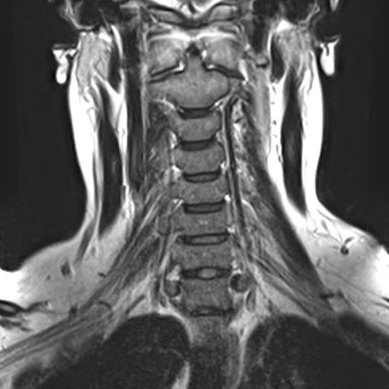 МРТ шейного отдела позвоночника, режим Т2, корональная плоскость