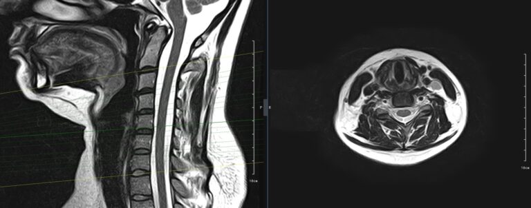 МРТ шейного отдела позвоночника, режим Т2, плоскости слева направо - сагиттальная, аксиальная