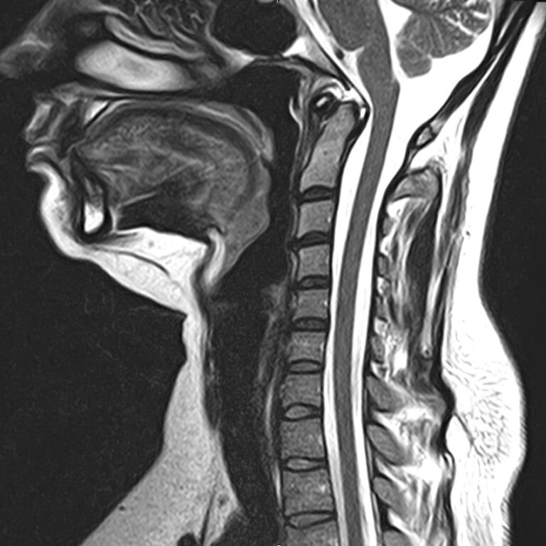 МРТ шейного отдела позвоночника, режим Т2, сагиттальная плоскость