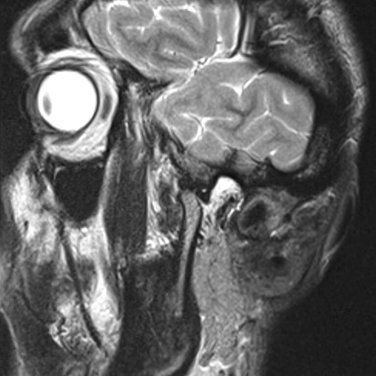 МРТ височно-нижнечелюстных суставов, открытый рот, режим Т2, сагиттальная плоскость