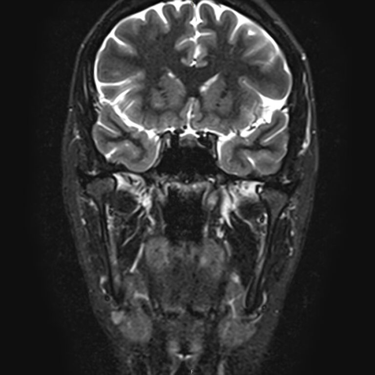 МРТ височно-нижнечелюстных суставов, режим STIR, корональная плоскость