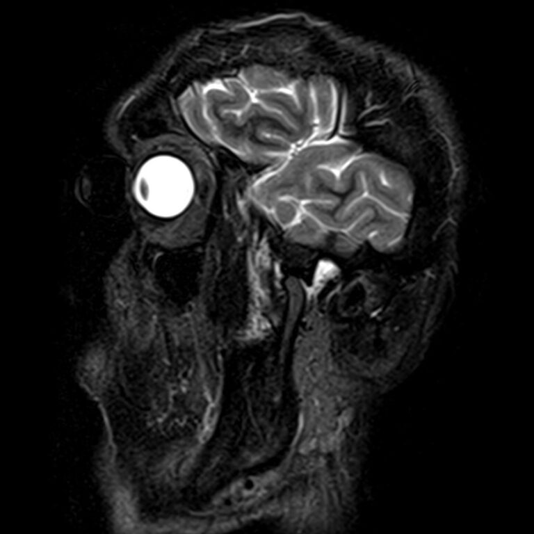 МРТ височно-нижнечелюстных суставов, режим STIR, сагиттальная плоскость