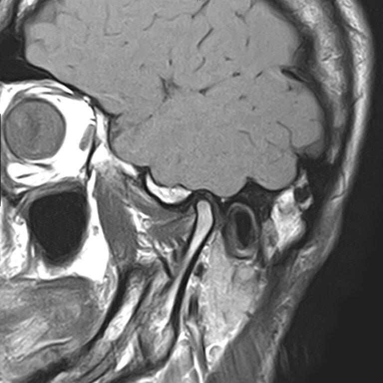 МРТ височно-нижнечелюстных суставов, режим Т1, сагиттальная плоскость