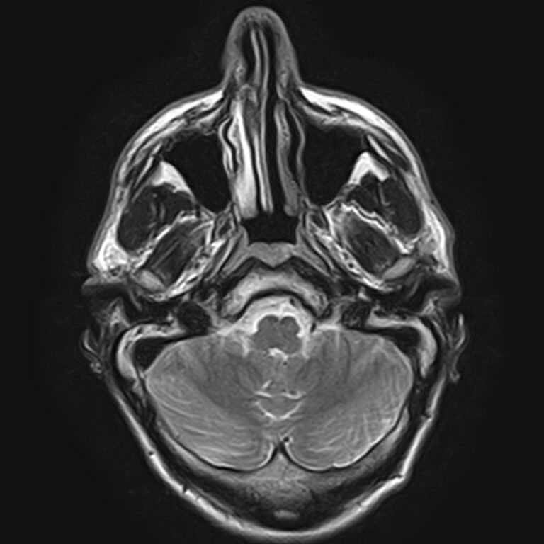 МРТ височно-нижнечелюстных суставов, режим Т2, аксиальная плоскость
