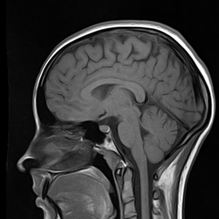 МРТ головного мозга, режим T1, сагиттальная плоскость