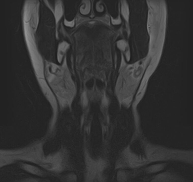 МРТ мягких тканей шеи