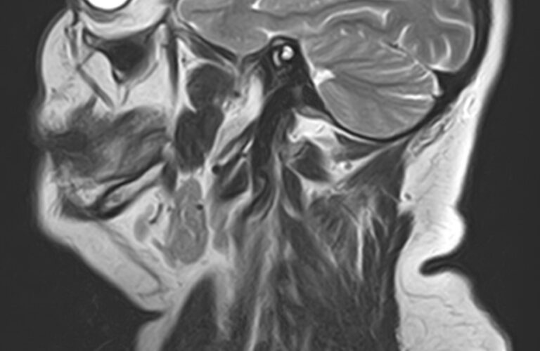 МРТ слюнных желез