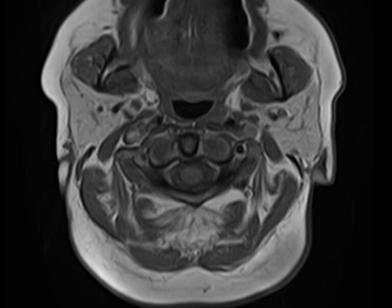 МРТ слюнных желез