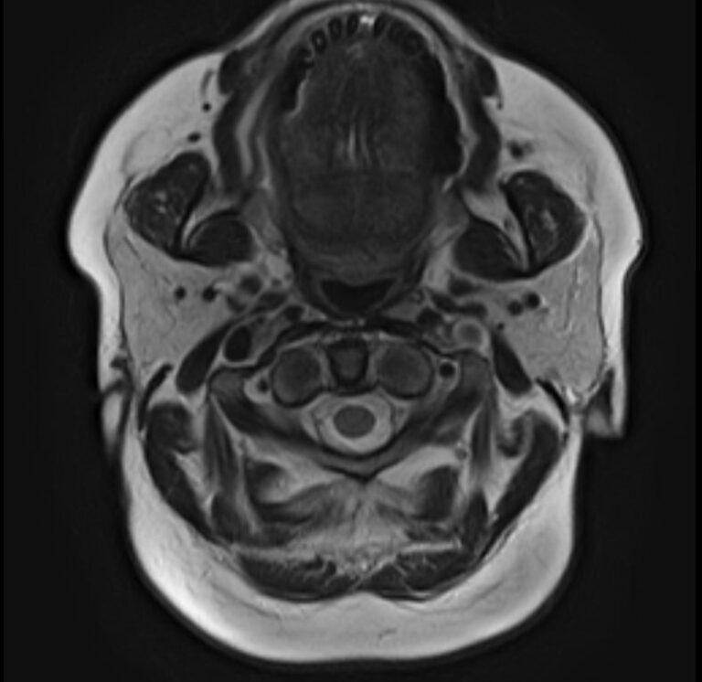 МРТ слюнных желез