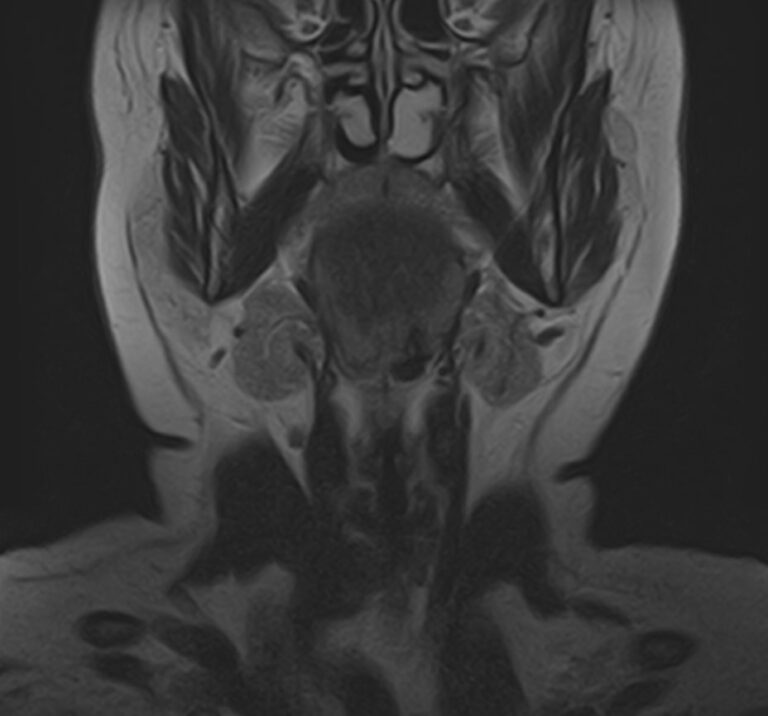 МРТ слюнных желез