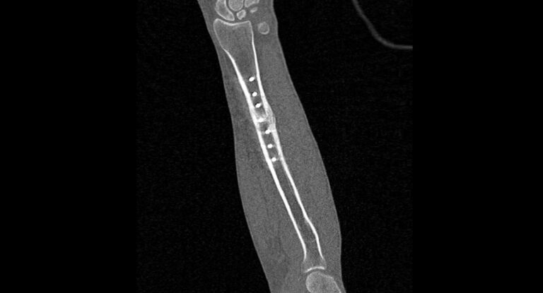 КТ предплечья