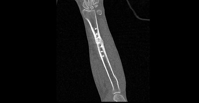 КТ предплечья