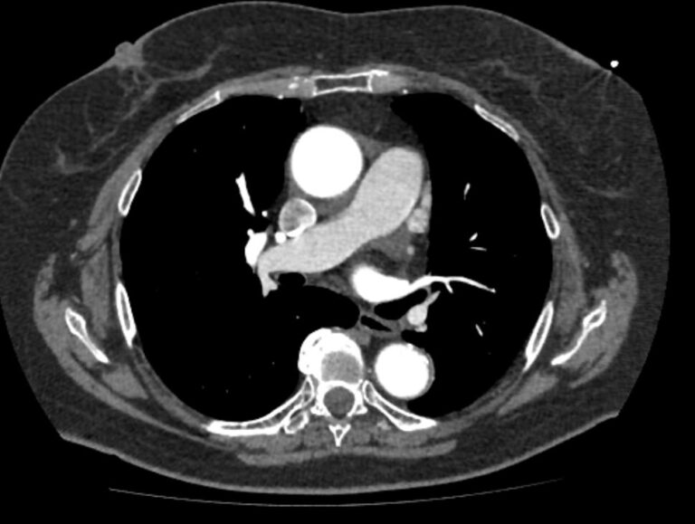 КТ грудного отдела аорты и ее ветвей