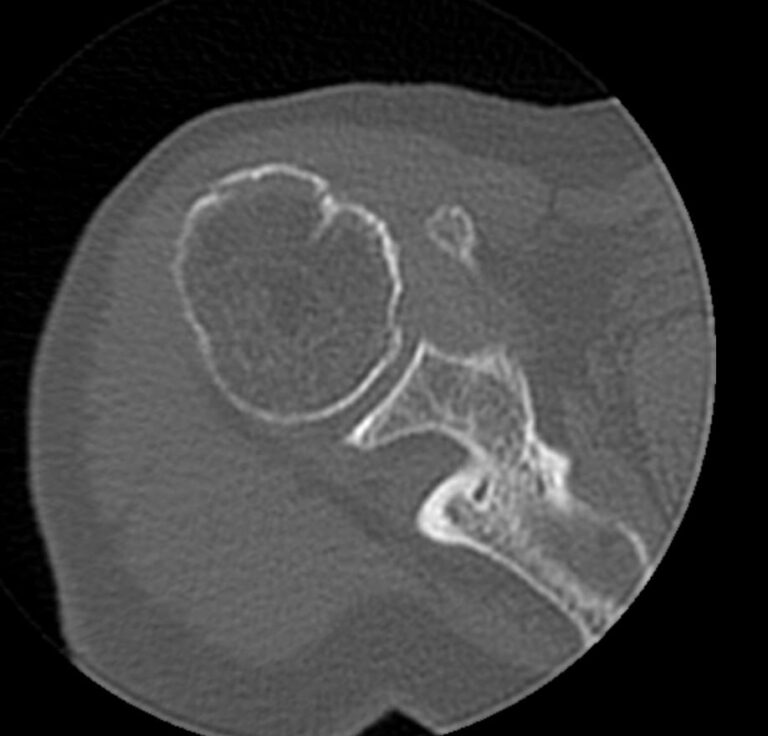 КТ плечевого сустава