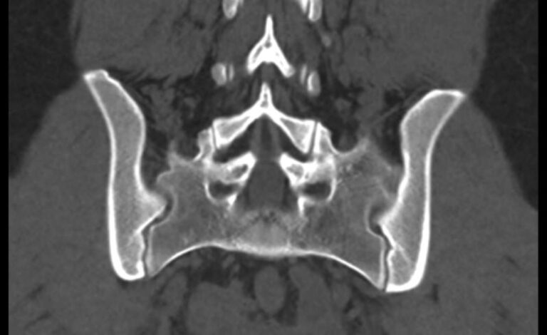 КТ крестцово-копчиковой области