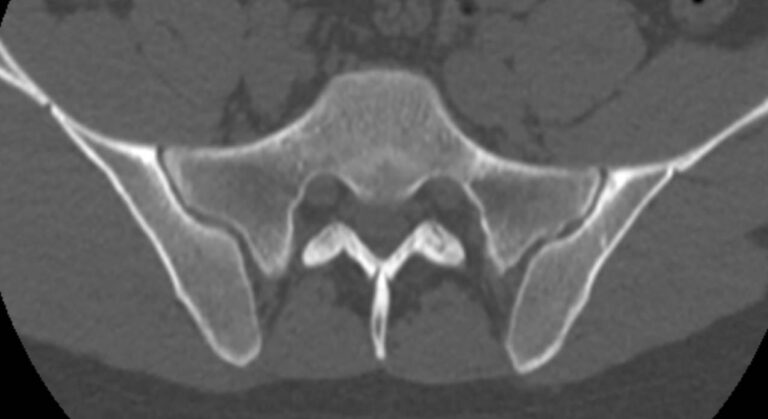 КТ крестцово-копчиковой области
