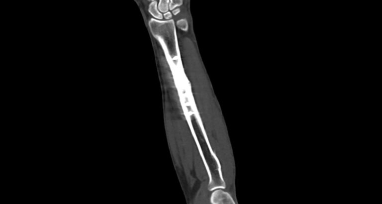 КТ предплечья