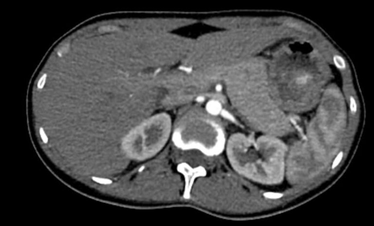 КТ сосудов почек