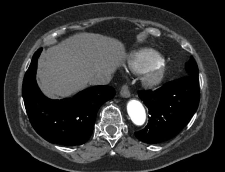КТ грудного отдела аорты и ее ветвей