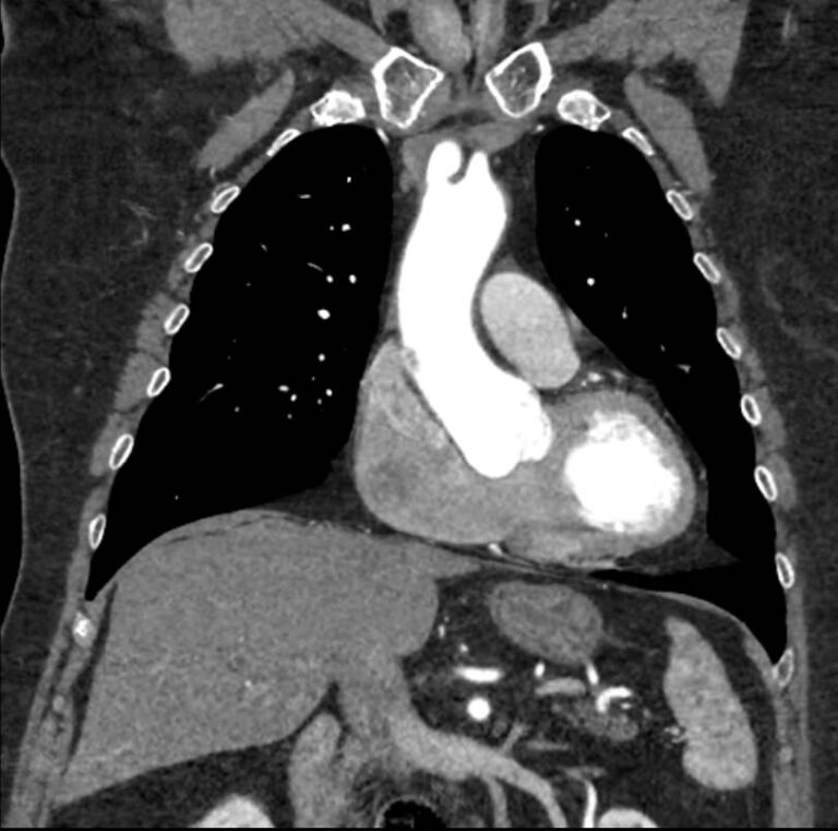 КТ грудного отдела аорты и ее ветвей