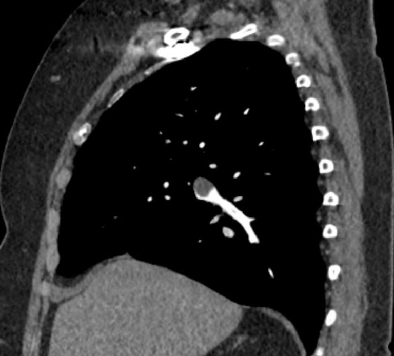 КТ легочной артерии и ее ветвей