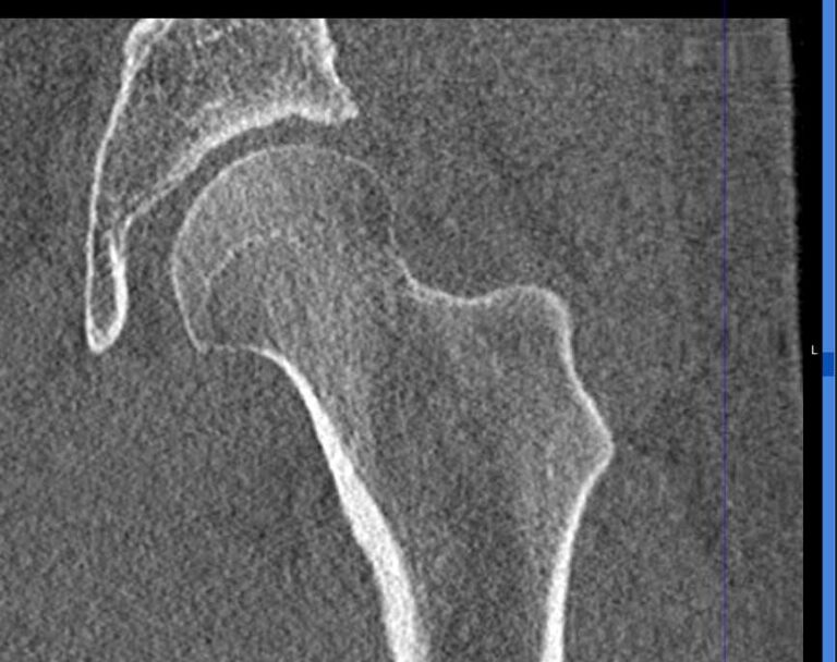 КТ тазобедренного сустава