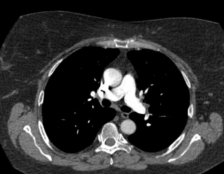 КТ легочной артерии и ее ветвей