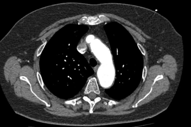 КТ грудного отдела аорты и ее ветвей