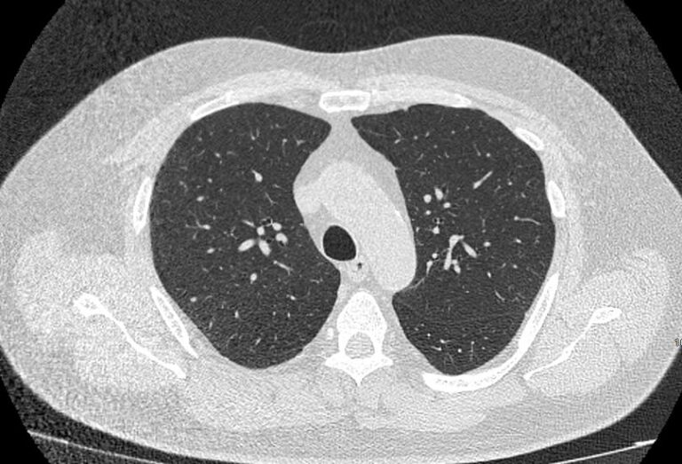 КТ легких