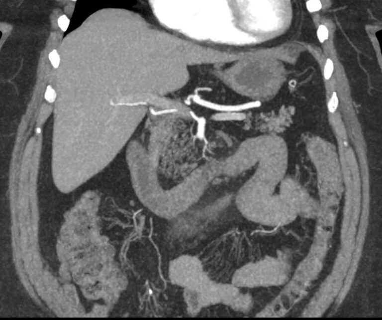 КТ лимфатических узлов с контрастом
