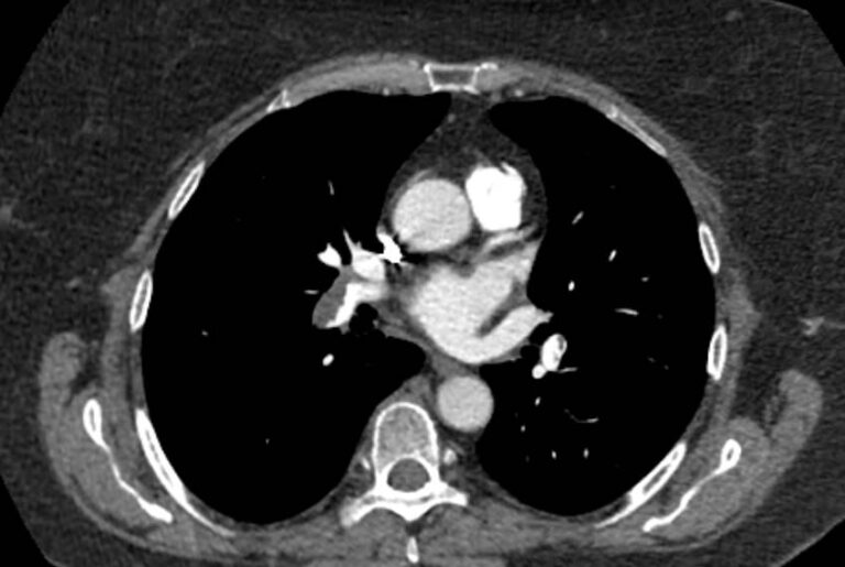 КТ легочной артерии и ее ветвей