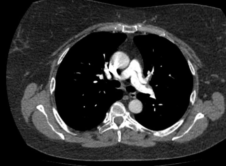 КТ легочной артерии и ее ветвей