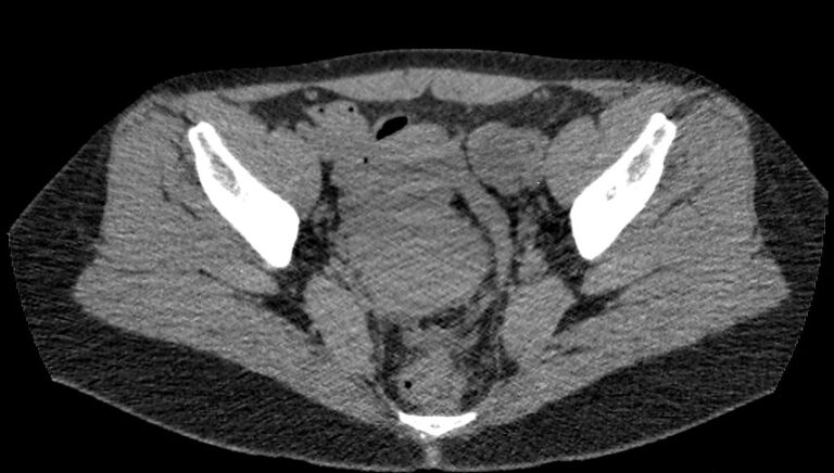 КТ почек, мочеточников и мочевого пузыря