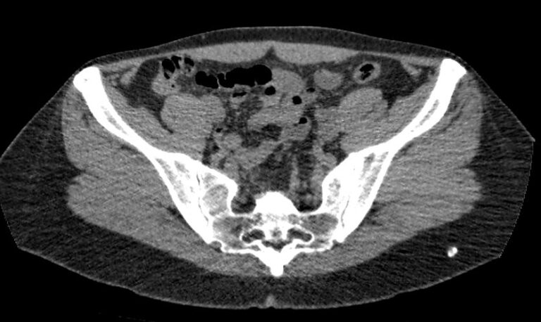 КТ почек, мочеточников и мочевого пузыря