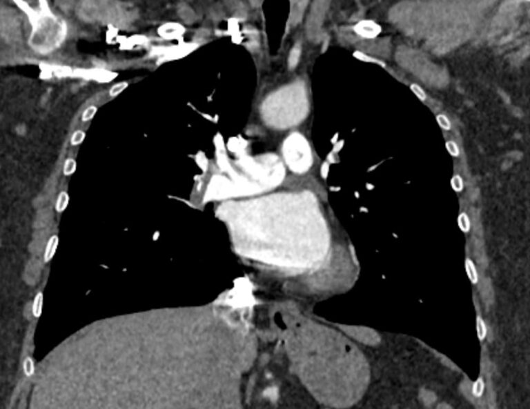 КТ легочной артерии и ее ветвей