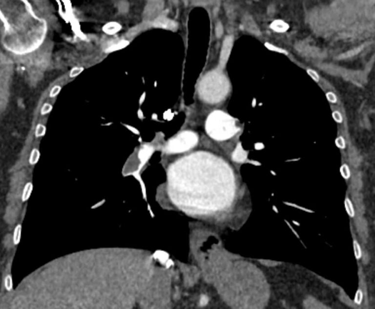 КТ легочной артерии и ее ветвей