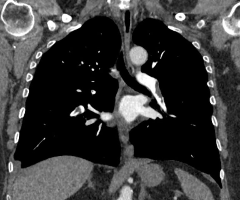 КТ легочной артерии и ее ветвей
