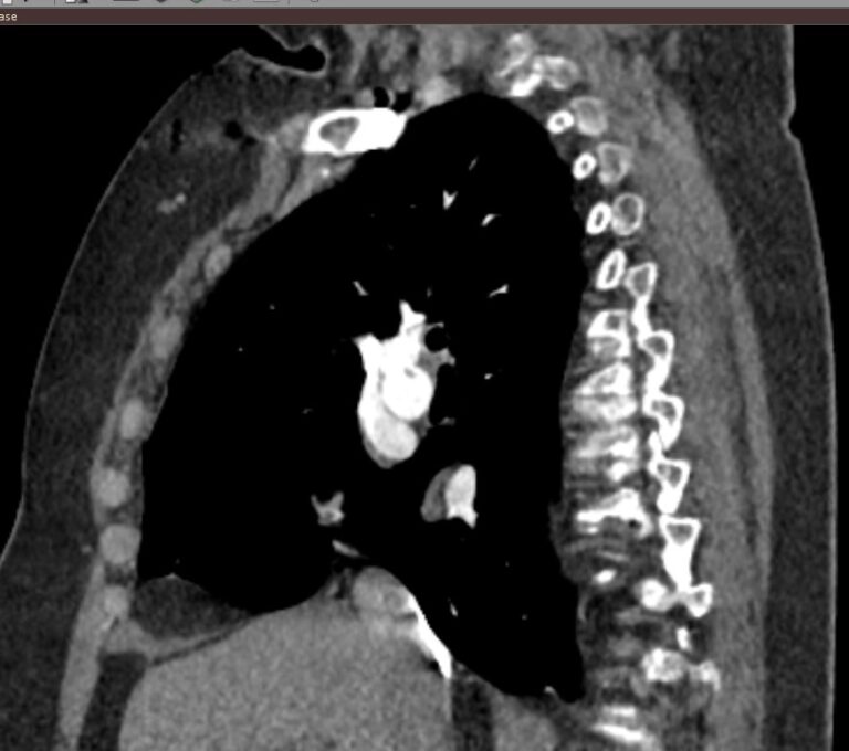 КТ легочной артерии и ее ветвей