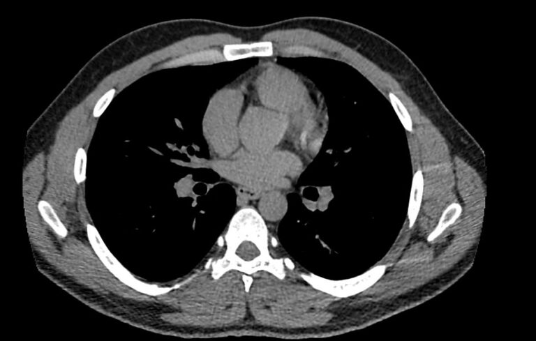 КТ органов средостения