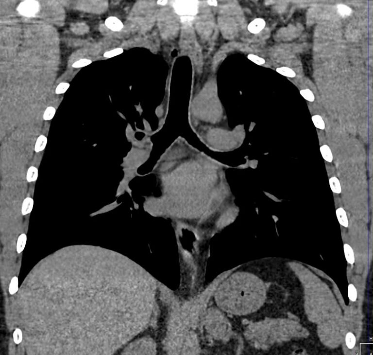 КТ органов средостения