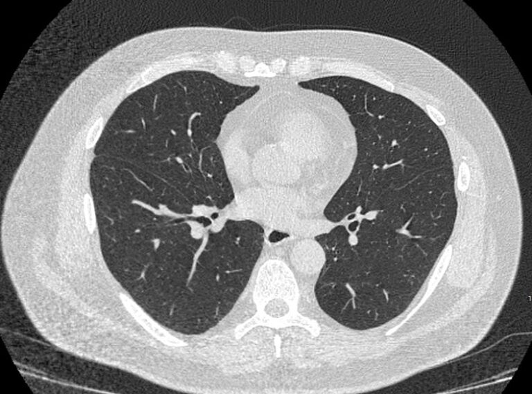 КТ легких
